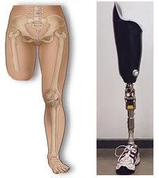 ABOVE KNEE AMPUTATION : Indication, Exercise, Prosthesis