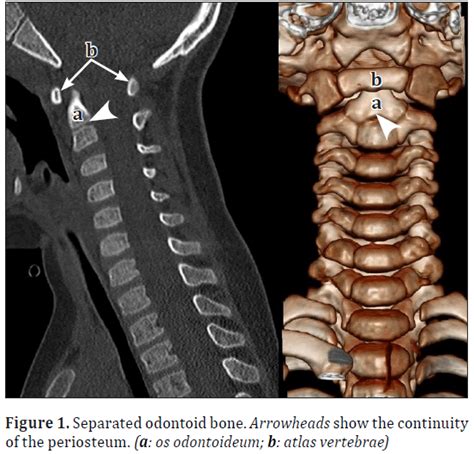 Dens fracture or odontoid bone