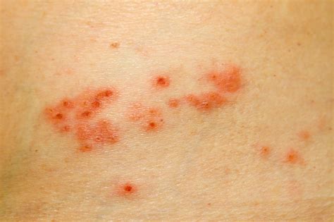 Home Remedies for Shingles | ThriftyFun