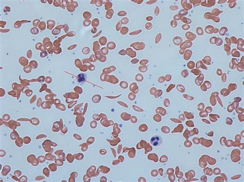 Sickle Cell Anemia Under Microscope