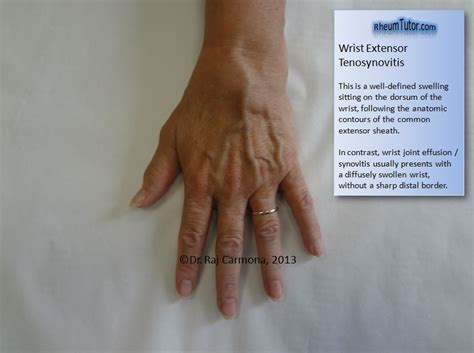 Wrist Extensor Tenosynovitis · RheumTutor