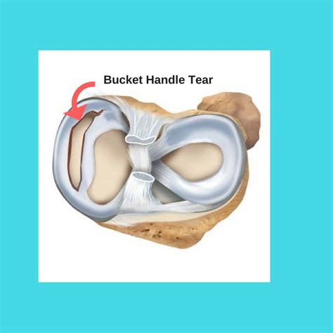 Bucket Handle Meniscus Tear – Howard J. Luks, MD