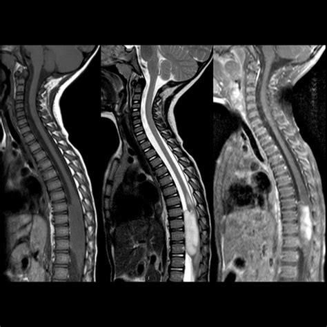 Toddler with back pain and scoliosis | Pediatric Radiology Case | Pediatric Imaging ...