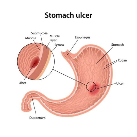 What are Stomach Ulcers? | Stomach Ulcer Symptoms, Causes, Treatmen