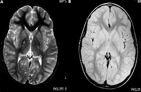 Unilateral lesions of the globus pallidus: report of four patients ...