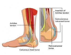 Bursitis Foot Treatment | Treatment For Foot Bursitis in Melbourne