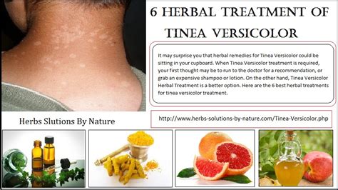 6 Herbal Treatment of Tinea Versicolor - Herbs Solutions By Nature