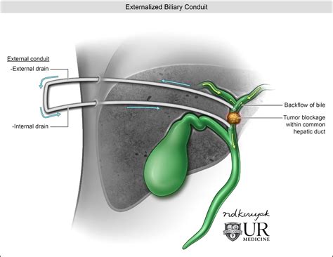 Types Of Biliary Drains