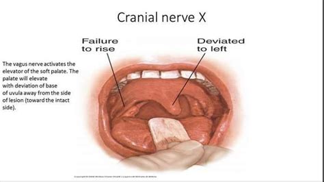 Uvula Deviation