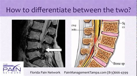 How to Differentiate Hip Pain Coming from the Hip or the Spine - YouTube