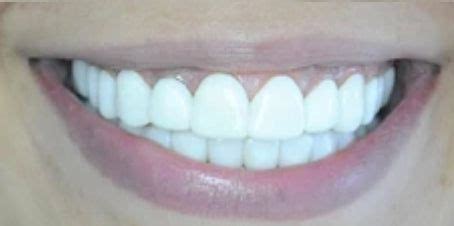 Press On Veneers Before and After - Photo Gallery – TruSmile Veneers ...