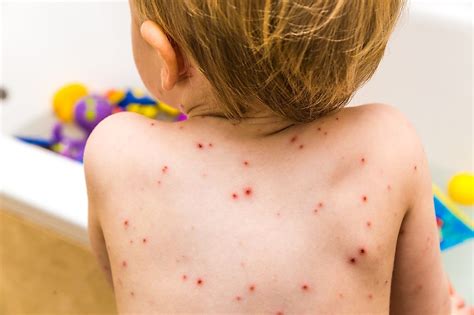 Chickenpox Facts: Diseases of the World - WorldAtlas.com