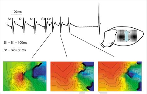 Nonsustained ventricular monomorphic VT after premature stimulation at... | Download Scientific ...