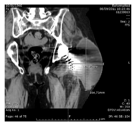 CT scan showing large septic joint fluid collection of the left hip ...