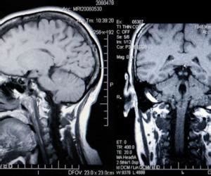 What are the Effects of a Lobotomy?