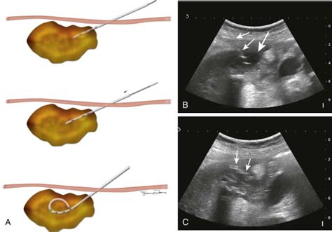 Abdominal Abscess Drainage