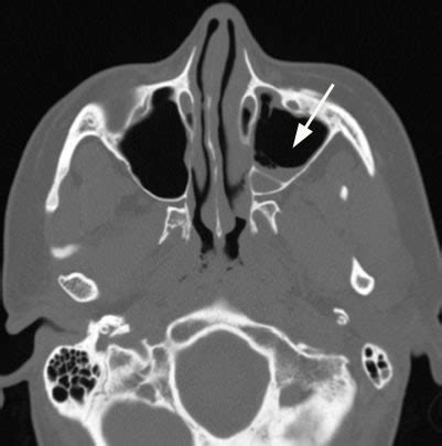 Radiologist For Ever: Paranasal sinuses rule 3 :Causes of sinus ...