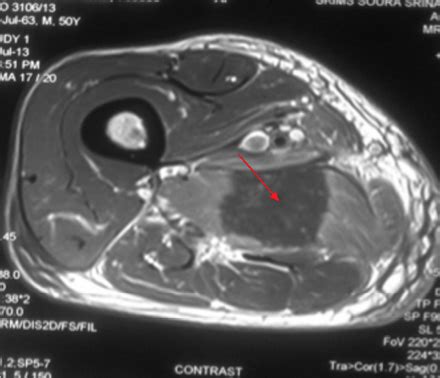 Figure 1B: Diffuse hyperintense signal on T2-weighted imaging suggestive of edema (red arrow).