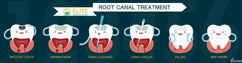 Root Canal Treatment (Endodontic Therapy) | Elite Dental Care