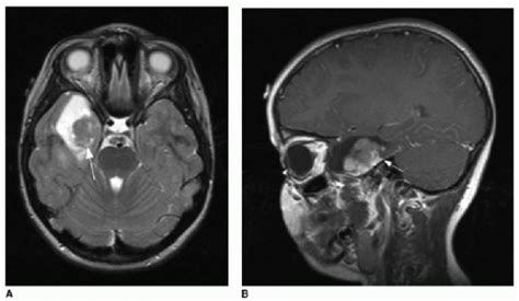 Brain Tumors | Radiology Key