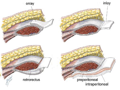 Onlay vs Inlay vs Sublay Mesh Repair For Hernia - MEDizzy