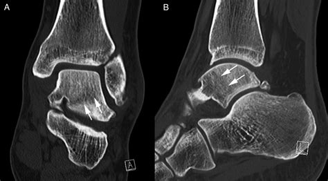 Fatigue Stress Fracture of the Talar Body: An Uncommon Cause of Ankle ...