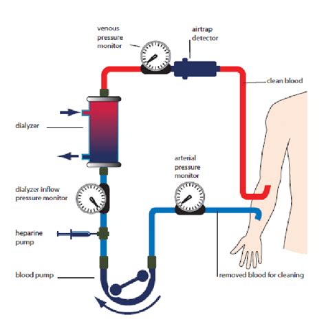 Hemodialysis Diagram