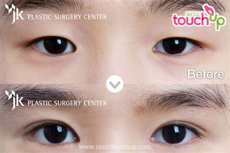 Epicanthoplasty Canthoplasty Before & After | Seoul TouchUp