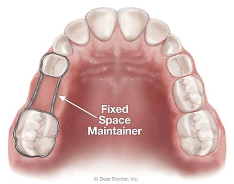 Space Maintainers | Merced Pediatric Dentistry | Merced California