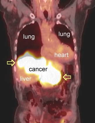 PET Scans in Cancer Cases