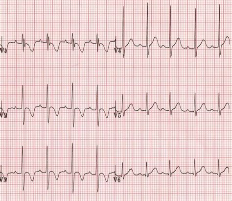 Inverted T waves are seen in the following conditions: Normal finding in children Persiste ...