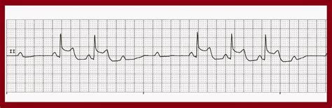 Float Nurse: Various 2nd Degree Heart Block Type II