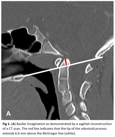 Basilar Invagination Article - StatPearls