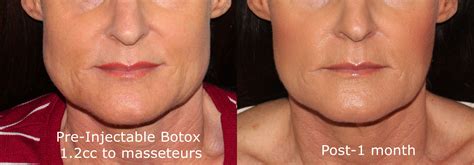 groff_botox_masseter_injections_wrinklereduction | Botox, Botox ...