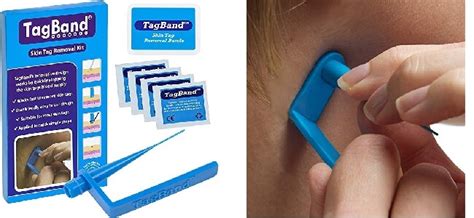 TagBand Skin Tag Removal Device Review - Does it Work, Really?