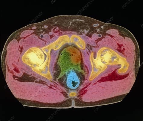 Prostate Mri Scan Showing Cancer