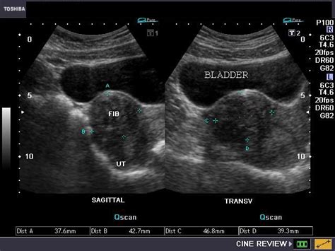 cochinblogs: Fibroids of the uterus (leiomyoma):