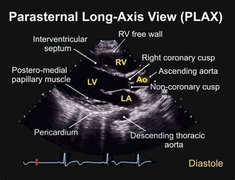 Parasternal long axis view TEE | Echocardiogram, Diagnostic medical ...