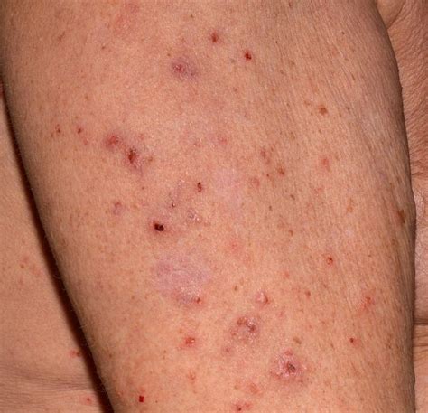 How Do You Get Scabies | causes, symptoms, treatment, pictures