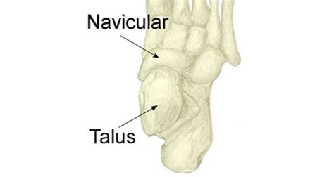 Stress Fracture of the Talus - Symptoms, Causes, Treatment & Rehab