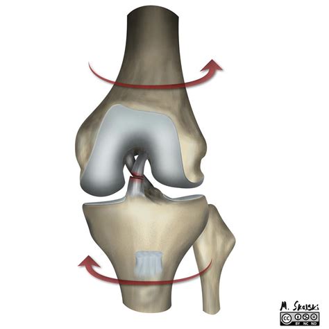 Diagram - anterior cruciate ligament injury | Radiology Case ...