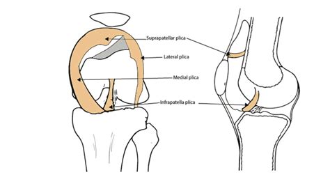 Medial Plica Syndrome: How to Treat It - Sport Doctor London