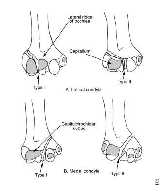 Medial Condyle Fracture Elbow