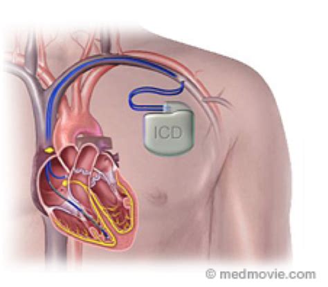 Cardiac Defibrillator - Concord Cardiology