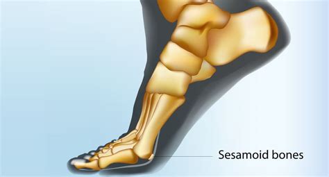 How to deal with issues with the sesamoid bone in the Foot