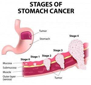 Stomach Cancer (Gastric Adenocarcinoma) Symptoms, Causes and Treatment | Science online