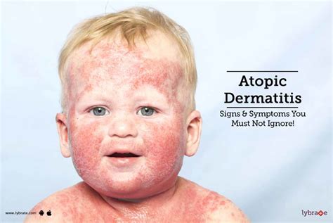 Atopic Dermatitis - Signs & Symptoms You Must Not Ignore! - By Dr. Gagandeep Singh Ahuja | Lybrate