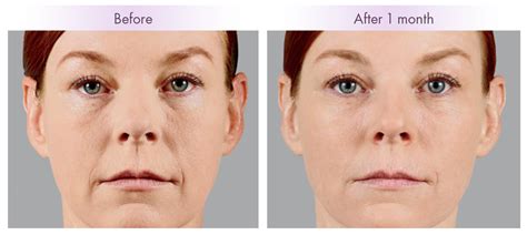 Using Fillers for Cheeks - Charleston Facial Plastic Surgery