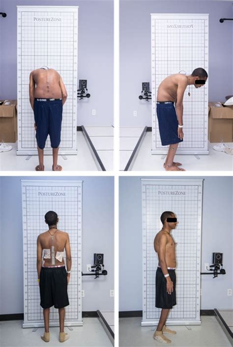 Fig. 1 | Clinical Gait Analysis on a Patient Undergoing Surgical Correction of Kyphosis from ...