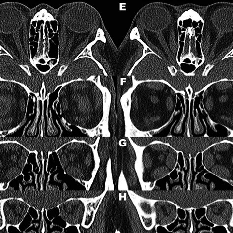 CT scan demonstrating bony remodeling of the orbit in TED. Images on ...